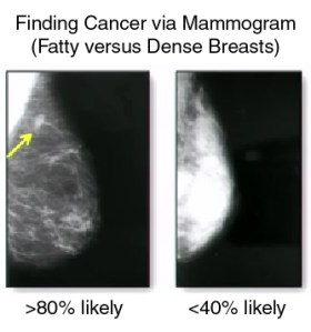 DenseBreastMammogram